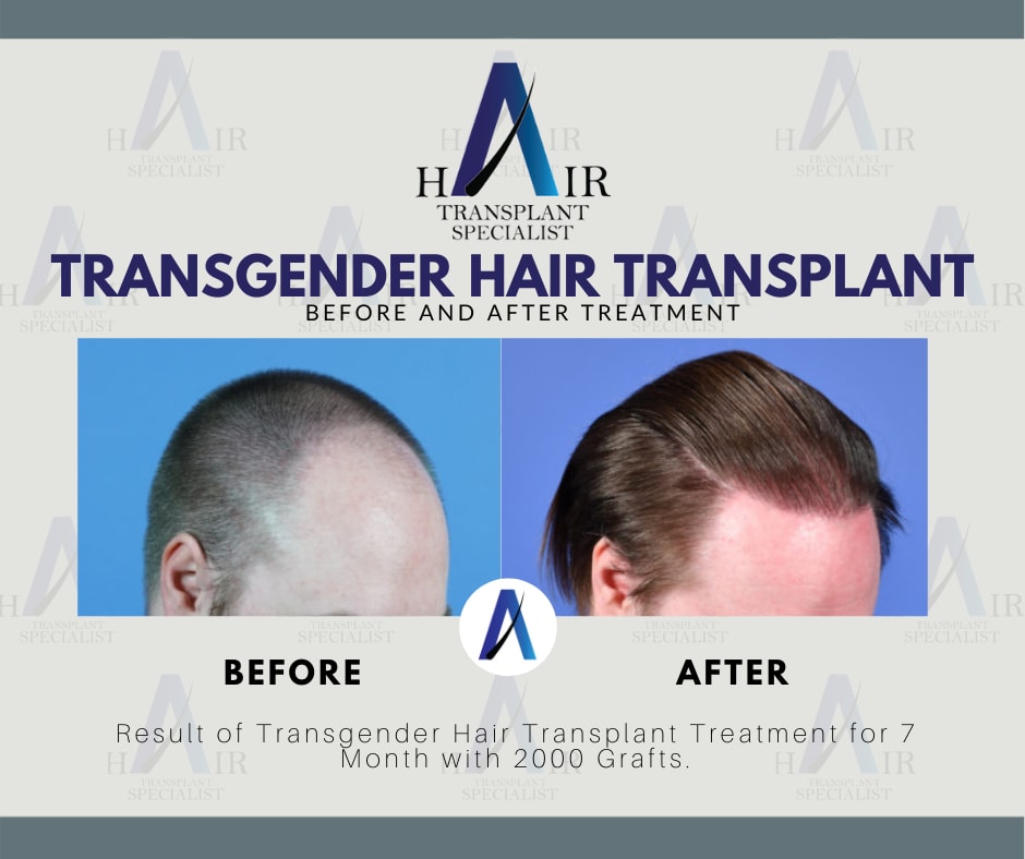 Hasil Transplantasi Rambut Transgender