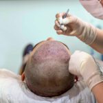 Transplantasi rambut dilakukan dengan hati-hati dan tepat