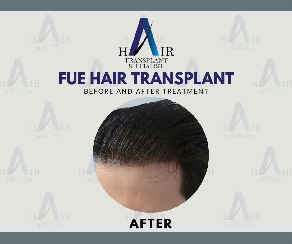 Hasil Perawatan untuk Transplantasi Rambut FUE