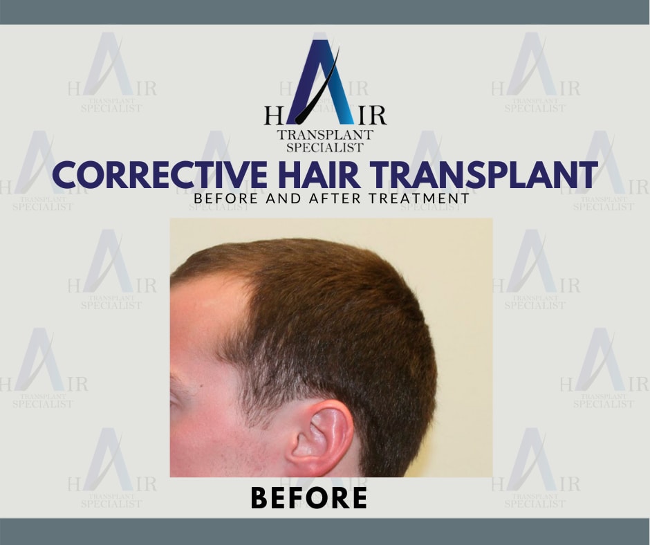 Transplantasi rambut korektif sebelum perawatan dengan tekmnik FUE