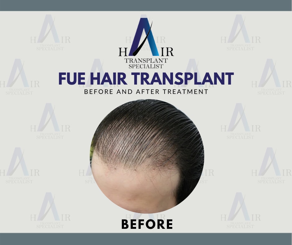 Sebelum Transplantasi Rambut FUE