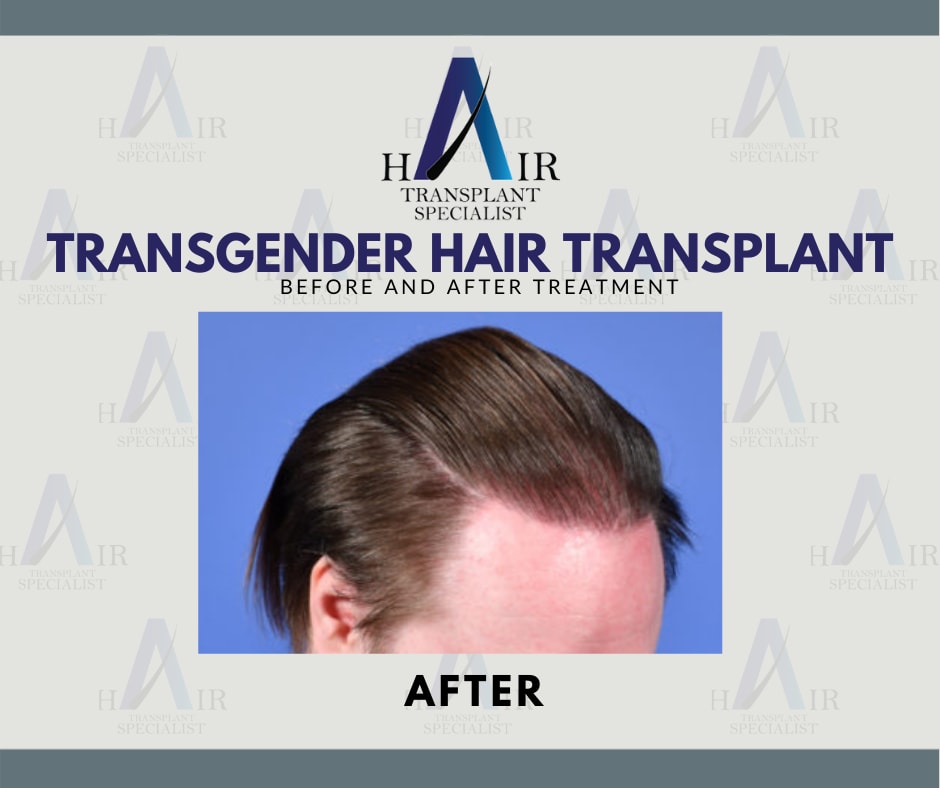 Penanaman Rambut Transgender