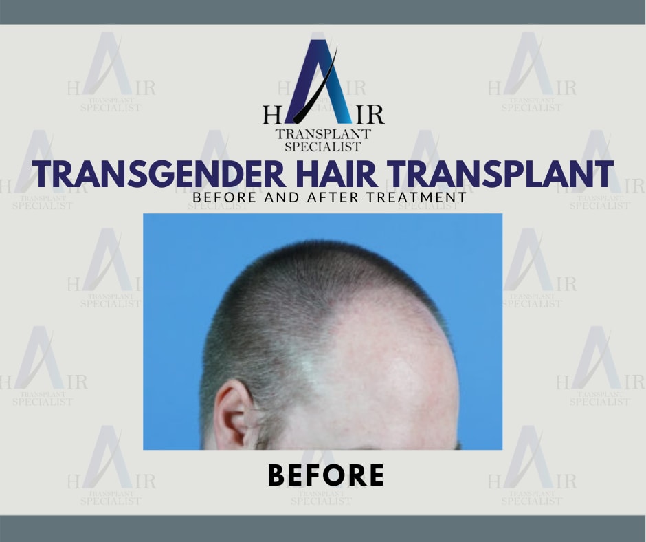 sebelum melalui rawatan transplantasi rambut
